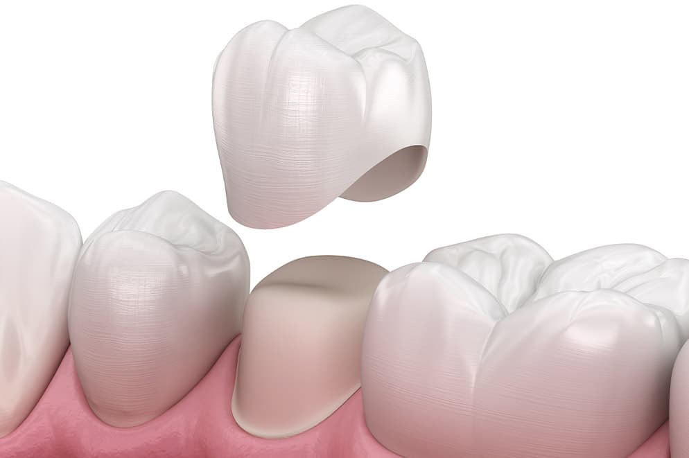 Krunica na prirodnim zubima